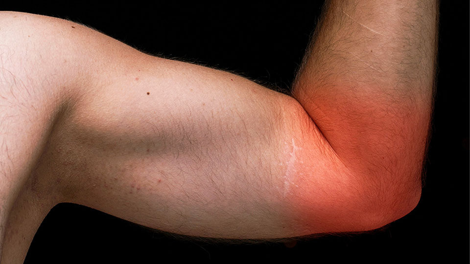 Gamer's Elbow, Esports Injury