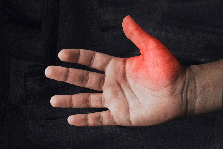 Gamer's Thumb, esports injury